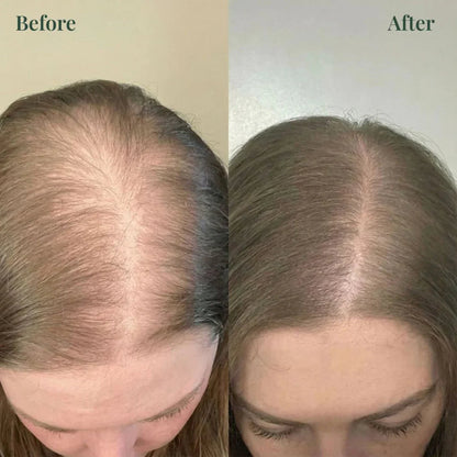 Kerarose Rosemary Shampoo For Hair Growth ( Buy 1 Get 1 Free 🔥)